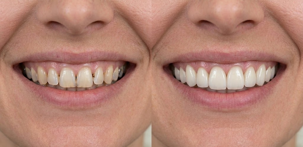 CEREC same-day crown