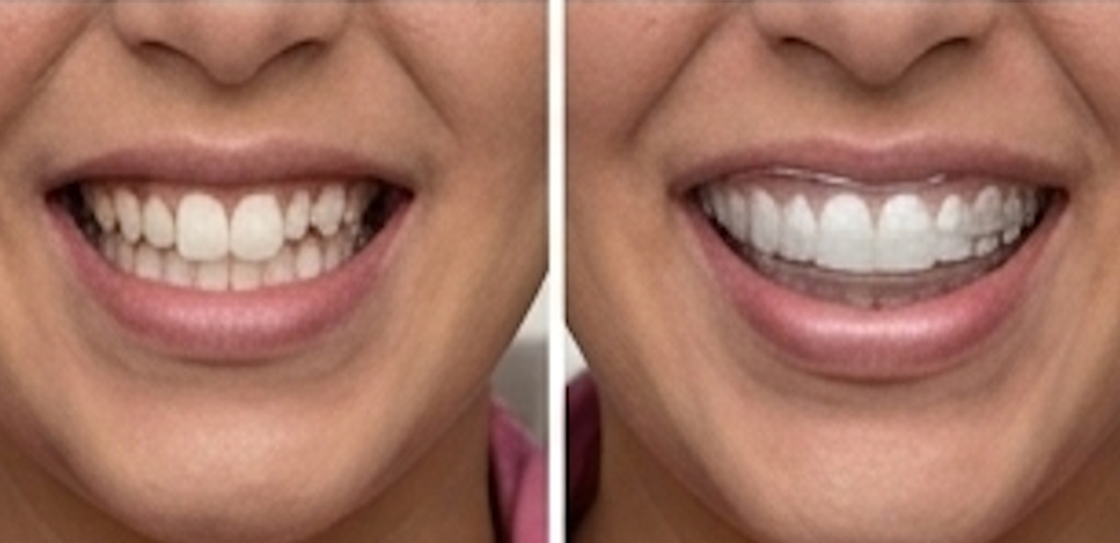 Porcelain veneers