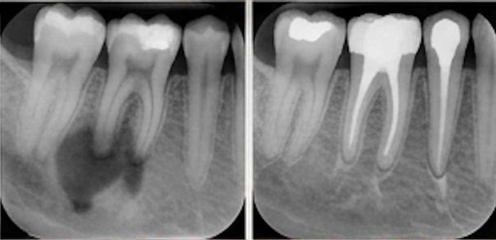 Modern root canal treatment using advanced technology